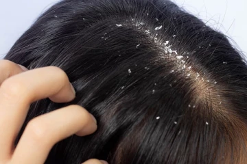 பொடுகால் முடி அரிப்பு ஏற்படுகின்றதா? இதனை போக்க இதோ அசத்தலான டிப்ஸ்