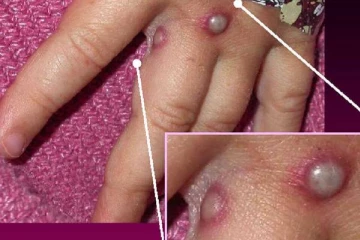 பிரான்ஸுக்குள் புகுந்தது குரங்கு அம்மை