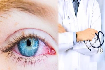 Madras Eye வந்தால் உடனே இதை செய்யுங்கள்: மருத்துவர் கூறும் ஆலோசனை