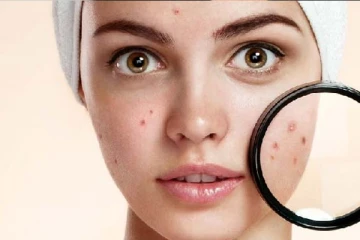 முகப்பரு தழும்புகளை எளிய முறையில் போக்க வேண்டுமா?