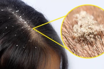 உங்களுக்கு பொடுகு தொல்லை தீரவே இல்லையா? இந்த எண்ணெயை மறக்கமால் யூஸ் பண்ணுங்க போதும்