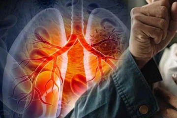 நாட்டில் வேகமாக அதிகரித்து வரும் நுரையீரல் புற்றுநோய் ; வைத்தியர்கள் விடுத்துள்ள எச்சரிக்கை