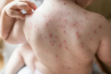 வெயிற்காலத்தில் ஏற்படும் அம்மை தழும்பு மறைக்க இதோ சில இயற்கை வைத்தியம்..!