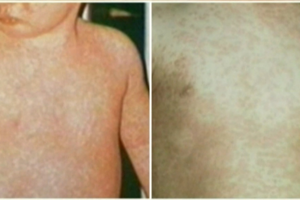 முக்கிய அந்தஸ்தொன்றை இழக்கும் அபாயத்தில் கனடா | Canada Likely To Lose Measles Elimination Status