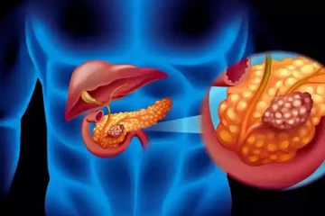 கணைய புற்றுநோய் தொடர்பான அறிகுறிகள்