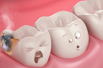 දත් දිරායාම - දත් කුහර ඇති වීමට බලපාන හේතු සහ සුව කරන පිළියම්.