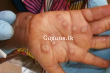 පිලිපීනයෙන් මාස ගණනකට පසු මන්කිපොක්ස් රෝගියෙක්...