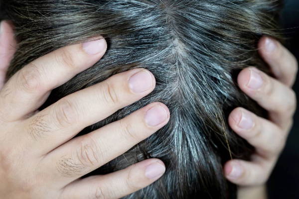 இளம் வயதில் நரை முடியா? காரணம் என்ன தெரியுமா? | Grey Hair At A Young Age This Could Be The Reason