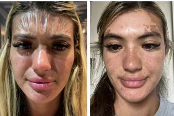 திடீரென பிளாஸ்டிக் போல் மாறிய பெண்ணின் முகம் - பிறகு பாம்பு தோல் போல உரிந்த அதிர்ச்சி