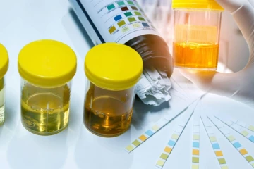 මුත්‍රා වල පැහැයෙන් හඳුනාගත හැකි රෝග මොනවද?