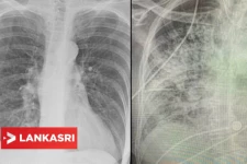 புகை பிடிப்பவர்களின் நுரையீரலைவிட மோசமாக பாதிக்கப்படும் கொரோனா தொற்றியவர்களின் நுரையீரல்: வெளியாகியுள்ள திடுக்கிடவைக்கும் எக்ஸ்ரே