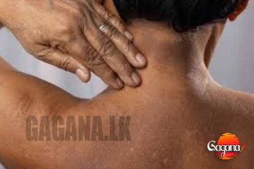 ඇඟ කසනවද? වහාම ප්‍රතිකාර ගන්න තවත් බරපතළ සෞඛ්‍ය අවදානමක්