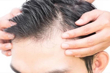 குறைந்த வயதில் தலை முடிகள் கொட்டி வழுக்கை விழுவதை தடுக்க என்ன செய்யலாம்?