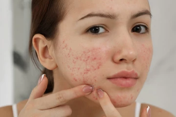 முகப்பருவிற்கு நிரந்தர தீர்வு தரும் சூப்பரான டிப்ஸ்! இதோ உங்களுக்காக