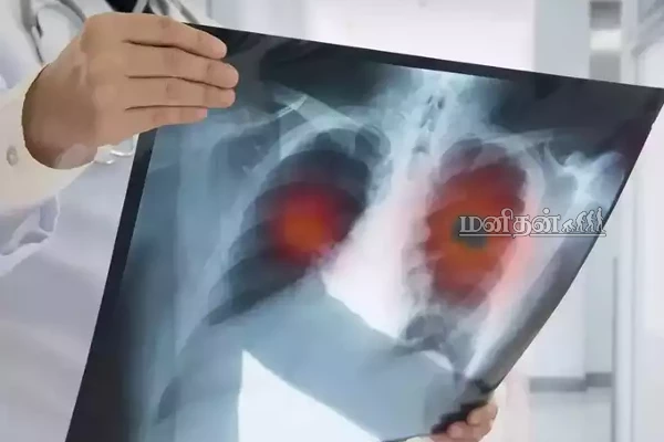 ஈரலில் கெட்ட நீர் தேங்கியிருந்தால் உயிருக்கு ஆபத்து! இந்த  அறிகுறி இருந்தால் உடனே மருத்துவரை நாடுங்கள் | Pulmonary Edema Symptoms In Tamil