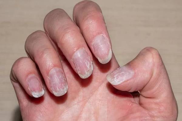 நகம் நொருங்குதா? அப்போ இந்த நோய் உங்களுக்கு இருக்கலாம் | Causes Of Brittle Nails