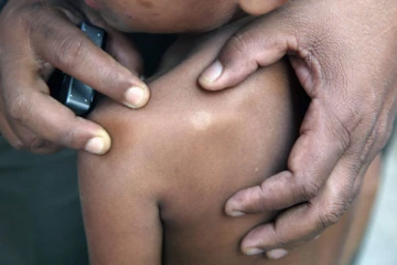 105 சிறுவர்கள் தொழுநோயால் பாதிப்பு