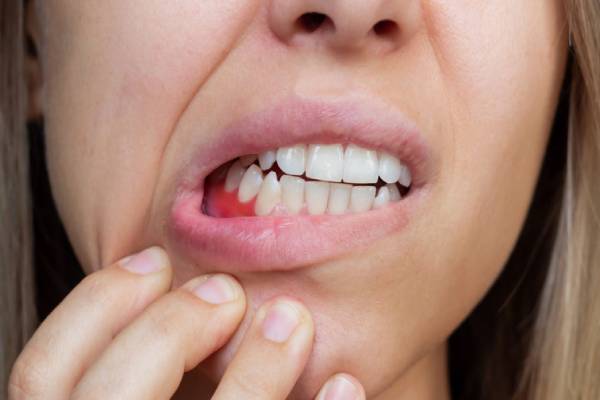 ஈறு அழற்சி பிரச்சினை முடிவுக்கட்டும் பூண்டு சாறு ஈறு அழற்சி பிரச்சினை முடிவுக்கட்டும் பூண்டு சாறு