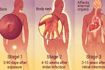 වැඩි ව්‍යාප්තියක් ඇති ලිංගාශ්‍රිත රෝග. - මේ රෝග ලක්ෂණ ගැන වැඩි අවදානයක් යොමු කරන්න.
