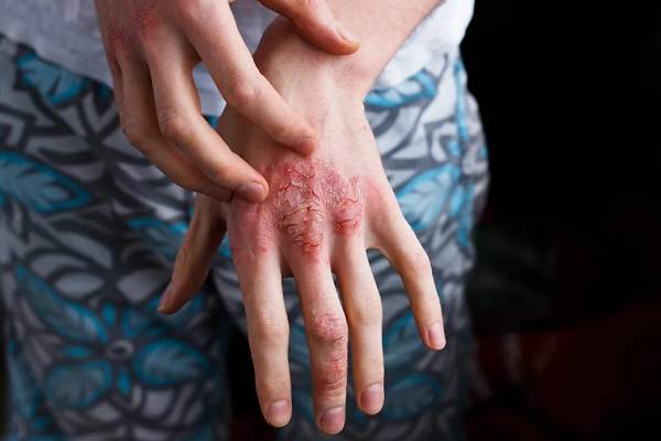 கர்ப்பிணிகளை குறி வைக்கும் சொரியாசிஸ்- எதனால் தெரியுமா? | What Causes Psoriasis In Pregnant Women கர்ப்பிணிகளை குறி வைக்கும் சொரியாசிஸ்- எதனால் தெரியுமா? | What Causes Psoriasis In Pregnant Women