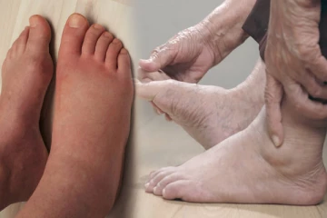 கால் அடிக்கடி வீங்குதா? உடனடி தீர்விற்கு இத செய்ங்க!