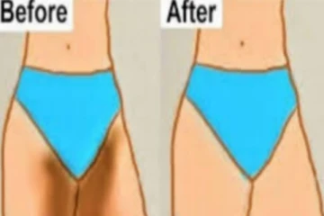 வெறும் 7 நாட்களில் தொடை கருமை நீங்க! அசத்தலான வீட்டு வைத்தியம்