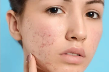 முகப்பருவால் ஏற்படும் தழும்புகளை மறைக்க வேண்டுமா? இதோ சூப்பரான 10 வழிகள்!