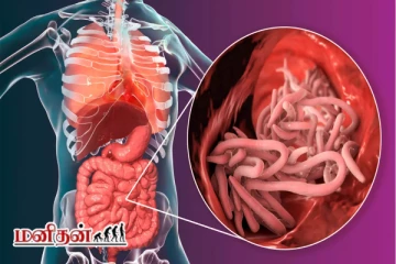 குழந்தைகளுக்கு ஏன் வயிற்றில் புழு வருகிறது? இதற்கு சிகிச்சை முறை இதோ