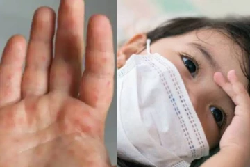 பரவி வரும் தக்காளி காய்ச்சல் - பீதியில் உறைந்த பெற்றோர்கள்