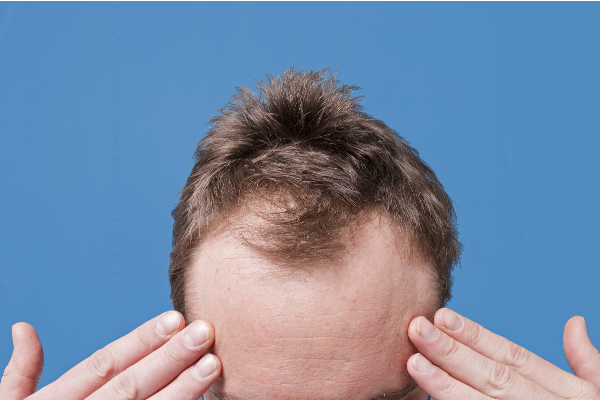 மொட்டை மண்டையிலும் 5 மடங்கு முடி அடர்த்தியாக வளரனுமா? இந்த ஒரே ஒரு பொருள் போதும் | Hair Growth Oil Onion