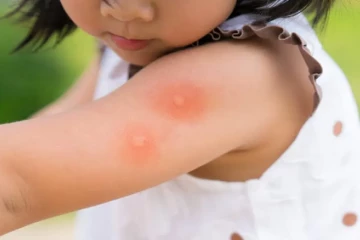 වෛද්‍යවරුන්ගෙන් දෙමව්පියන්ට විශේෂ ඉල්ලීමක් - දරුවන්ට උණ රෝගය පවතීනම් ප්‍රමාද නොවන්න