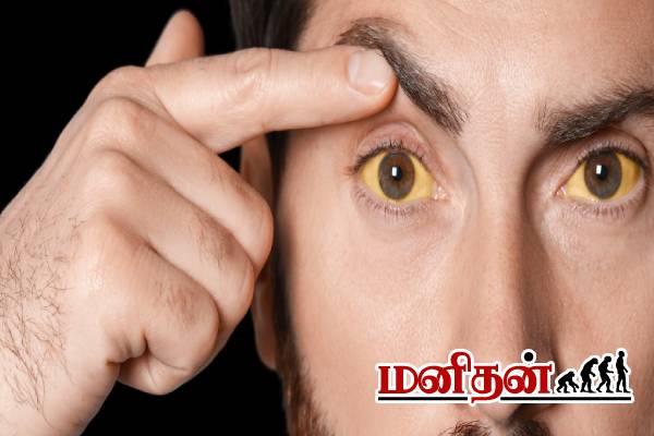 மஞ்சள் காமாலை நோய்: மருத்துவரின் விரிவான விளக்கம் | Jaundice About Full Details In Tamil