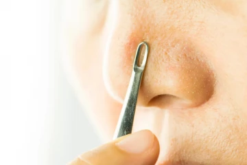 முகத்தில் உள்ள கரும்புள்ளியை போக்கும் வீட்டு வைத்தியம்; என்ன செய்யலாம்?