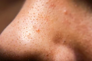 மூக்கு மேல் இருக்கிற கரும்புள்ளி வேகமாக போகனுமா? இதோ சூப்பர் டிப்ஸ்