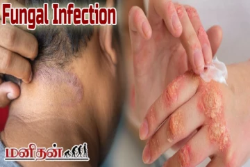 பூஞ்சை தொற்று எவ்வாறு ஏற்படுகிறது? இந்த வீட்டு வைத்தியத்தை முறைப்படி செய்ங்க