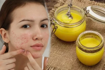 தேனுடன் நெய் கலந்து முகத்தில் தடவுங்க... முகப்பரு தொல்லையே இருக்காதாம்