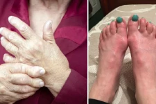 மாடர்னா தடுப்பூசி போட்டவர்களுக்கு ஏற்பட்ட பக்கவிளைவுகள் குறித்து அமெரிக்க FDA வெளியிட்ட முக்கிய தகவல்