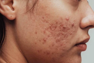 பருவால் வந்த தழும்பு முகத்தில் அசிங்கமா இருக்கா? இதனை போக்க இதோ சூப்பரான டிப்ஸ்