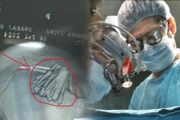 பெண்ணின் தலையில் 77 ஊசிகளை ஏற்றிய சாமியார்! அதிர்ச்சியில் உறைந்த மருத்துவர்கள்