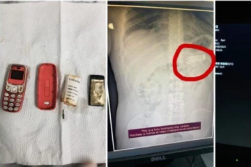 NOKIA செல்போனை விழுங்கிய நபர்! பரிசோதித்த டாக்டருக்கு காத்திருந்த அதிர்ச்சி.. பின்னர் நடந்தது என்ன?