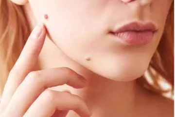 முகத்தில் இருக்கும் இந்த சின்ன சின்ன மருக்களை நீக்க வேண்டுமா? இதோ சூப்பரான டிப்ஸ்