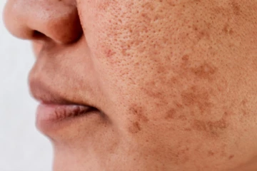 சருமத்தில் உள்ள எப்பேர்ப்பட்ட கருந்திட்டுகளையும் போக்க வேண்டுமா?