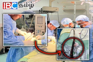 கழுத்தில் பாய்ந்த கூரிய தடி : வெற்றிகரமாக உயிரை காப்பாற்றிய வைத்தியர்கள்