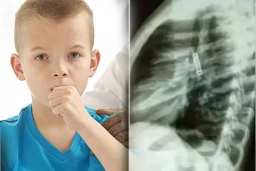 5 வயது சிறுவனுக்கு 3 மாதங்களாக நிற்காத இருமல்..!எக்ஸ்ரே படத்தை பார்த்து அதிர்ச்சியடைந்த மருத்துவர்கள்