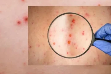 මන්කිපොක්ස් සම්බන්ධයෙන් මෙරටදී අද සිට ක්‍රියාත්මක නව වැඩපිළිවෙල..