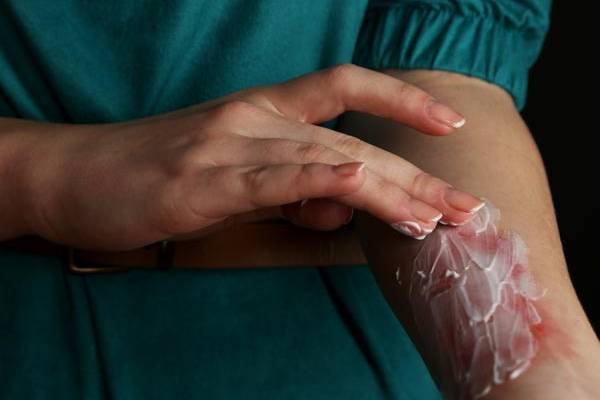 தீக்காயம் ஏற்பட்டால் இந்த தவறை மட்டும் பண்ணாதீங்க! பாதிப்பு உறுதி | How To Treat Minor Cooking Burns