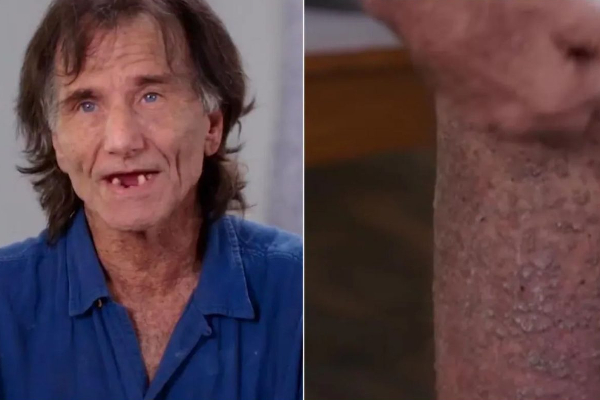 நரக வேதனை தான்; முதலை போன்ற தோலால் கதறும் நபர் - உருக்கமான வீடியோ | American Man Suffers Crocodile Like Skin