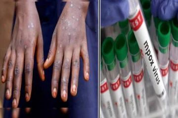 இந்திய மக்களை தாக்கும் 1-பி வகை குரங்கம்மை பாதிப்பு- அறிகுறிகள் என்ன?