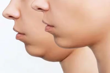 இரட்டை கன்னம் உங்களை அசிங்கமா காட்டுகிறதா? அப்போ இப்படி பண்ணுங்க