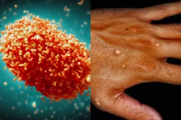 තවත් වසංගත අවදානමක් ලෝකයටම.. භයානක රෝගයක් පැතිරයන ලකුණු..